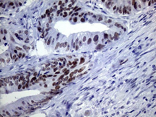 TSEN34 Antibody - Immunohistochemical staining of paraffin-embedded Adenocarcinoma of Human colon tissue using anti-TSEN34 mouse monoclonal antibody. (Heat-induced epitope retrieval by 1mM EDTA in 10mM Tris buffer. (pH8.5) at 120°C for 3 min. (1:150)