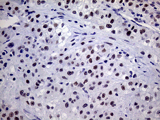 TSEN34 Antibody - Immunohistochemical staining of paraffin-embedded Carcinoma of Human kidney tissue using anti-TSEN34 mouse monoclonal antibody. (Heat-induced epitope retrieval by 1mM EDTA in 10mM Tris buffer. (pH8.5) at 120°C for 3 min. (1:150)