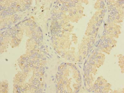 TSGA10 Antibody - Immunohistochemistry of paraffin-embedded human prostate cancer using antibody at dilution of 1:100.