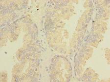 TSGA10 Antibody - Immunohistochemistry of paraffin-embedded human prostate cancer using antibody at dilution of 1:100.