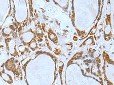 TSGA10 Antibody - Immunohistochemistry of paraffin-embedded Human thyroid cancer tissue  using TSGA10 Polyclonal Antibody at dilution of 1:50(×200)