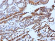 TSH Receptor / TSHR Antibody - IHC testing of FFPE human thyroid carcinoma with TSH Receptor antibody (clone SPM222). Required HIER: boil tissue sections in 10mM Tris buffer with 1mM EDTA, pH 8, for 10-20 min followed by cooling at RT for 20 min.