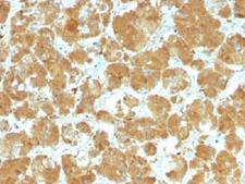 TSH Receptor / TSHR Antibody - IHC testing of FFPE human thyroid carcinoma with TSHR antibody (clone TSHRA/1402). Required HIER: boil tissue sections in 10mM Tris with 1mM EDTA, pH 9, or 10mM citrate buffer, pH 6, for 10-20 min followed by cooling at RT for 20 min.