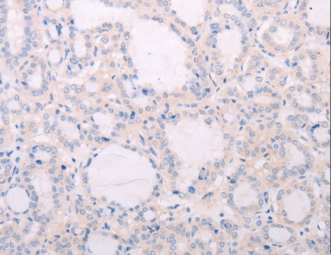 TSH Receptor / TSHR Antibody - Immunohistochemistry of paraffin-embedded Human lung cancer using TSHR Polyclonal Antibody at dilution of 1:50.