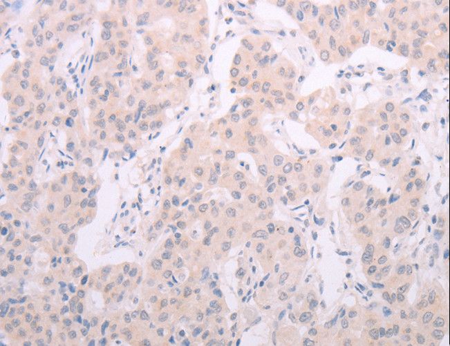 TSH Receptor / TSHR Antibody - Immunohistochemistry of paraffin-embedded Human lung cancer using TSHR Polyclonal Antibody at dilution of 1:50.