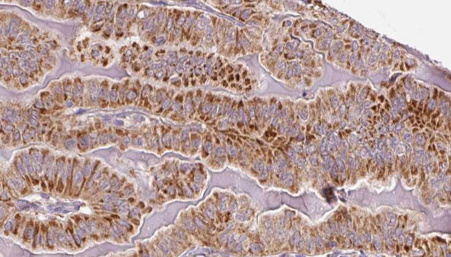 TSH Receptor / TSHR Antibody - 1:100 staining human thyroid carcinoma tissue by IHC-P. The sample was formaldehyde fixed and a heat mediated antigen retrieval step in citrate buffer was performed. The sample was then blocked and incubated with the antibody for 1.5 hours at 22°C. An HRP conjugated goat anti-rabbit antibody was used as the secondary.