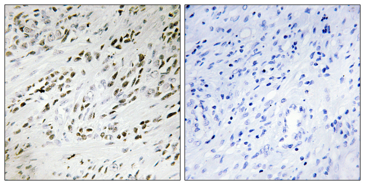 TSHZ2 Antibody - Immunohistochemistry analysis of paraffin-embedded human prostate carcinoma tissue, using TSH2 Antibody. The picture on the right is blocked with the synthesized peptide.