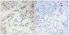 TSHZ2 Antibody - Peptide - + Immunohistochemistry analysis of paraffin-embedded human prostate carcinoma tissue, using TSH2 antibody.