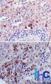 TSLP Antibody - Immunohistochemistry-Paraffin: TSLP Antibody (55N1D10) - Formalin-fixed, paraffin-embedded normal human spleen (top) and human lung carcinoma (bottom) stained with TSLP antibody (1 ug/ml), peroxidase-conjugate and DAB chromogen.  This image was taken for the unconjugated form of this product. Other forms have not been tested.