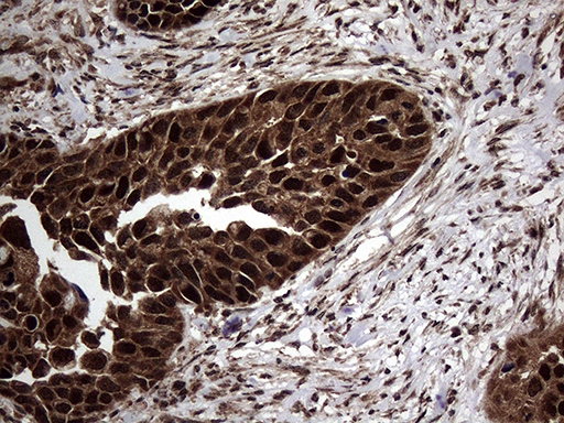 TSN / Translin Antibody - Immunohistochemical staining of paraffin-embedded Carcinoma of Human kidney tissue using anti-TSN mouse monoclonal antibody. (Heat-induced epitope retrieval by 1mM EDTA in 10mM Tris buffer. (pH8.5) at 120°C for 3 min. (1:500)