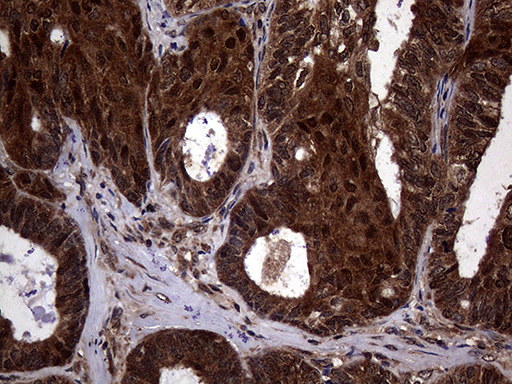 TSN / Translin Antibody - Immunohistochemical staining of paraffin-embedded Adenocarcinoma of Human ovary tissue using anti-TSN mouse monoclonal antibody. (Heat-induced epitope retrieval by 1mM EDTA in 10mM Tris buffer. (pH8.5) at 120°C for 3 min. (1:500)