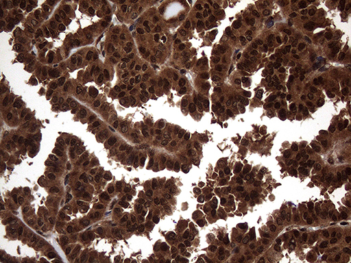 TSN / Translin Antibody - Immunohistochemical staining of paraffin-embedded Carcinoma of Human thyroid tissue using anti-TSN mouse monoclonal antibody. (Heat-induced epitope retrieval by 1mM EDTA in 10mM Tris buffer. (pH8.5) at 120°C for 3 min. (1:500)