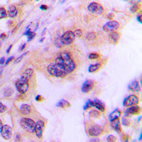 TSN / Translin Antibody - Immunohistochemical analysis of Translin staining in human lung cancer formalin fixed paraffin embedded tissue section. The section was pre-treated using heat mediated antigen retrieval with sodium citrate buffer (pH 6.0). The section was then incubated with the antibody at room temperature and detected using an HRP conjugated compact polymer system. DAB was used as the chromogen. The section was then counterstained with hematoxylin and mounted with DPX.