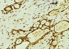 TSN / Translin Antibody - 1:100 staining human breast carcinoma tissue by IHC-P. The sample was formaldehyde fixed and a heat mediated antigen retrieval step in citrate buffer was performed. The sample was then blocked and incubated with the antibody for 1.5 hours at 22°C. An HRP conjugated goat anti-rabbit antibody was used as the secondary.