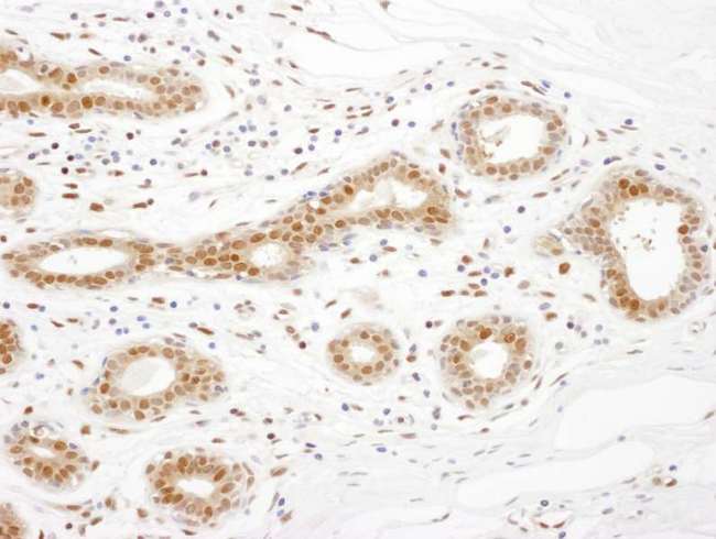 TSNAX / TRAX Antibody - Detection of human TRAX by immunohistochemistry. Sample: FFPE section of human breast carcinoma. Antibody: Affinity purified rabbit anti- TRAX used at a dilution of 1:5,000 (0.2µg/ml). Detection: DAB