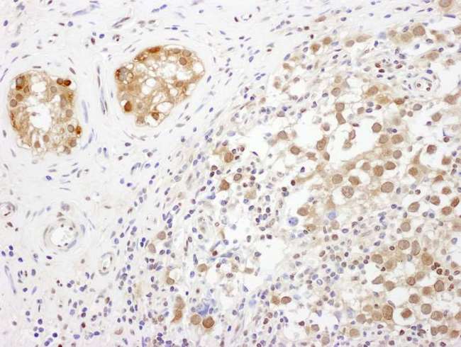 TSNAX / TRAX Antibody - Detection of human TRAX by immunohistochemistry. Sample: FFPE section of human testicular seminoma. Antibody: Affinity purified rabbit anti- TRAX used at a dilution of 1:5,000 (0.2µg/ml). Detection: DAB. Counterstain: IHC Hematoxylin (blue).