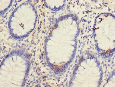 TSPAN1 / TM4SF Antibody - Immunohistochemistry of paraffin-embedded human colon cancer using antibody at dilution of 1:100.