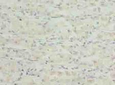TSPAN33 / PEN Antibody - Immunohistochemistry of paraffin-embedded human gastric cancer using antibody at dilution of 1:100.