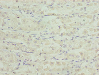 TSPAN33 / PEN Antibody - Immunohistochemistry of paraffin-embedded human gastric cancer using TSPAN33 Antibody at dilution of 1:100