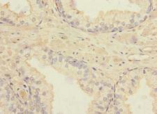 TSPAN4 Antibody - Immunohistochemistry of paraffin-embedded human prostate cancer at dilution 1:100