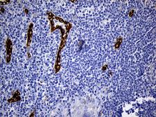 TSPAN7 / CD231 Antibody - Immunohistochemical staining of paraffin-embedded Carcinoma of Human thyroid tissue using anti-TSPAN7 mouse monoclonal antibody. (Heat-induced epitope retrieval by 1mM EDTA in 10mM Tris buffer. (pH8.5) at 120°C for 3 min. (1:500)