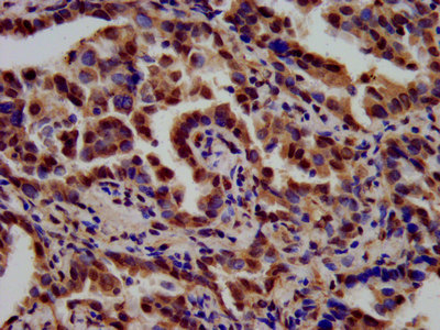 TSPAN9 Antibody - Immunohistochemistry image at a dilution of 1:700 and staining in paraffin-embedded human lung cancer performed on a Leica BondTM system. After dewaxing and hydration, antigen retrieval was mediated by high pressure in a citrate buffer (pH 6.0) . Section was blocked with 10% normal goat serum 30min at RT. Then primary antibody (1% BSA) was incubated at 4 °C overnight. The primary is detected by a biotinylated secondary antibody and visualized using an HRP conjugated SP system.
