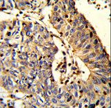 TSPEAR Antibody - Formalin-fixed and paraffin-embedded human Lung carcinoma reacted with C21orf29 Antibody , which was peroxidase-conjugated to the secondary antibody, followed by DAB staining. This data demonstrates the use of this antibody for immunohistochemistry; clinical relevance has not been evaluated.