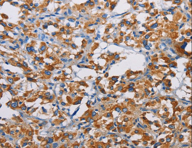 TSPEAR Antibody - Immunohistochemistry of paraffin-embedded Human liver cancer using TSPEAR Polyclonal Antibody at dilution of 1:50.
