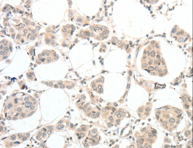TSPYL2 / DENTT Antibody - Immunohistochemistry of paraffin-embedded Human breast cancer using TSPYL2 Polyclonal Antibody at dilution of 1:30.
