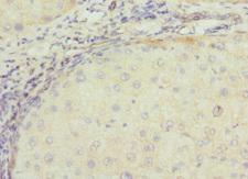 TSSK3 / STK22C Antibody - Immunohistochemistry of paraffin-embedded human liver cancer at dilution 1:100