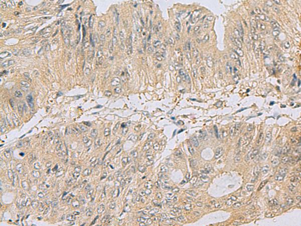 TSTA3 /  GDP-L-Fucose Synthase Antibody - Immunohistochemistry of paraffin-embedded Human colorectal cancer tissue  using TSTA3 Polyclonal Antibody at dilution of 1:80(×200)