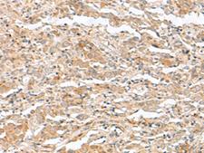 TTC12 Antibody - Immunohistochemistry of paraffin-embedded Human cervical cancer tissue  using TTC12 Polyclonal Antibody at dilution of 1:40(×200)