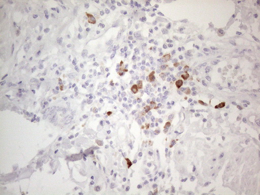 TTC14 Antibody - Immunohistochemical staining of paraffin-embedded Adenocarcinoma of Human colon tissue using anti-TTC14 mouse monoclonal antibody. (Heat-induced epitope retrieval by 1mM EDTA in 10mM Tris buffer. (pH8.5) at 120°C for 3 min. (1:150)