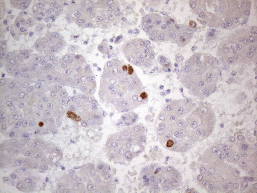 TTC14 Antibody - Immunohistochemical staining of paraffin-embedded Carcinoma of Human liver tissue using anti-TTC14 mouse monoclonal antibody. (Heat-induced epitope retrieval by 1mM EDTA in 10mM Tris buffer. (pH8.5) at 120°C for 3 min. (1:150)