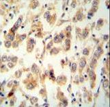 TTC16 Antibody - TTC16 antibody immunohistochemistry of formalin-fixed and paraffin-embedded human testis carcinoma followed by peroxidase-conjugated secondary antibody and DAB staining.