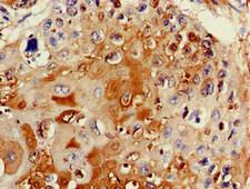 TTC19 Antibody - Immunohistochemistry image of paraffin-embedded human cervical cancer at a dilution of 1:100