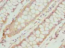 TTC30A Antibody - Immunohistochemistry of paraffin-embedded human colon cancer using antibody at dilution of 1:100.