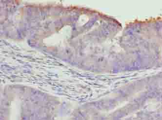 TTC30A Antibody - Immunohistochemistry of paraffin-embedded human endometrial cancer using antibody at dilution of 1:100.
