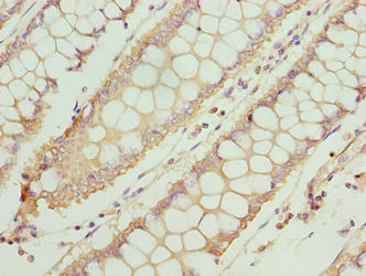 TTC30A Antibody - Immunohistochemistry of paraffin-embedded human colon cancer using TTC30A Antibody at dilution of 1:100
