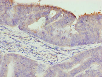 TTC30A Antibody - Immunohistochemistry of paraffin-embedded human endometrial cancer using TTC30A Antibody at dilution of 1:100