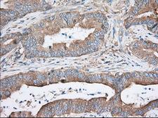 TTC32 Antibody - Immunohistochemical staining of paraffin-embedded Adenocarcinoma of Human colon tissue using anti-TTC32 mouse monoclonal antibody. (Dilution 1:50).