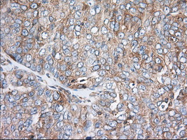 TTC32 Antibody - Immunohistochemical staining of paraffin-embedded Adenocarcinoma of Human ovary tissue using anti-TTC32 mouse monoclonal antibody. (Dilution 1:50).