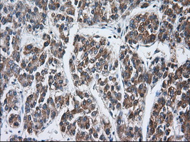 TTC32 Antibody - Immunohistochemical staining of paraffin-embedded Carcinoma of Human liver tissue using anti-TTC32 mouse monoclonal antibody. (Dilution 1:50).