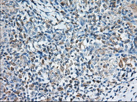 TTC32 Antibody - IHC of paraffin-embedded Carcinoma of Human thyroid tissue using anti-TTC32 mouse monoclonal antibody. (Dilution 1:50).