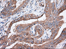TTC32 Antibody - IHC of paraffin-embedded Adenocarcinoma of Human colon tissue using anti-TTC32 mouse monoclonal antibody. (Dilution 1:50).