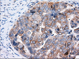 TTC32 Antibody - IHC of paraffin-embedded Adenocarcinoma of Human ovary tissue using anti-TTC32 mouse monoclonal antibody. (Dilution 1:50).