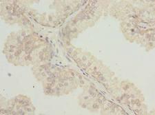 TTC38 Antibody - Immunohistochemistry of paraffin-embedded human prostate cancer using antibody at dilution of 1:100.