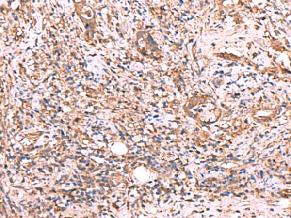TTC38 Antibody - Immunohistochemistry of paraffin-embedded Human cervical cancer tissue  using TTC38 Polyclonal Antibody at dilution of 1:50(×200)