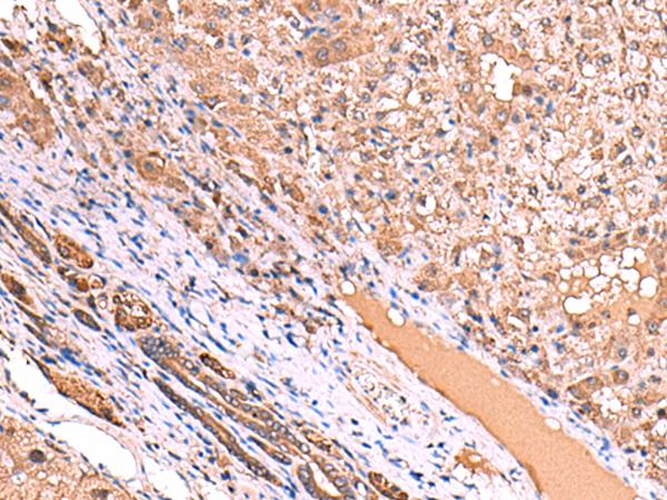 TTC38 Antibody - Immunohistochemistry of paraffin-embedded Human liver cancer tissue  using TTC38 Polyclonal Antibody at dilution of 1:85(×200)