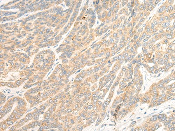TTC4 Antibody - Immunohistochemistry of paraffin-embedded Human liver cancer tissue  using TTC4 Polyclonal Antibody at dilution of 1:45(×200)